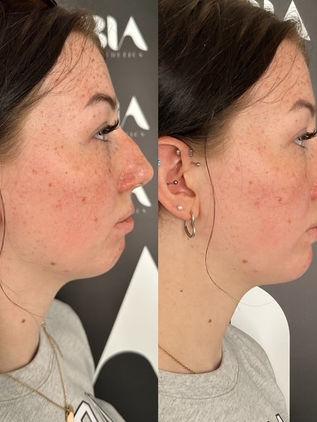 Lady showing before and after results of chin filler 