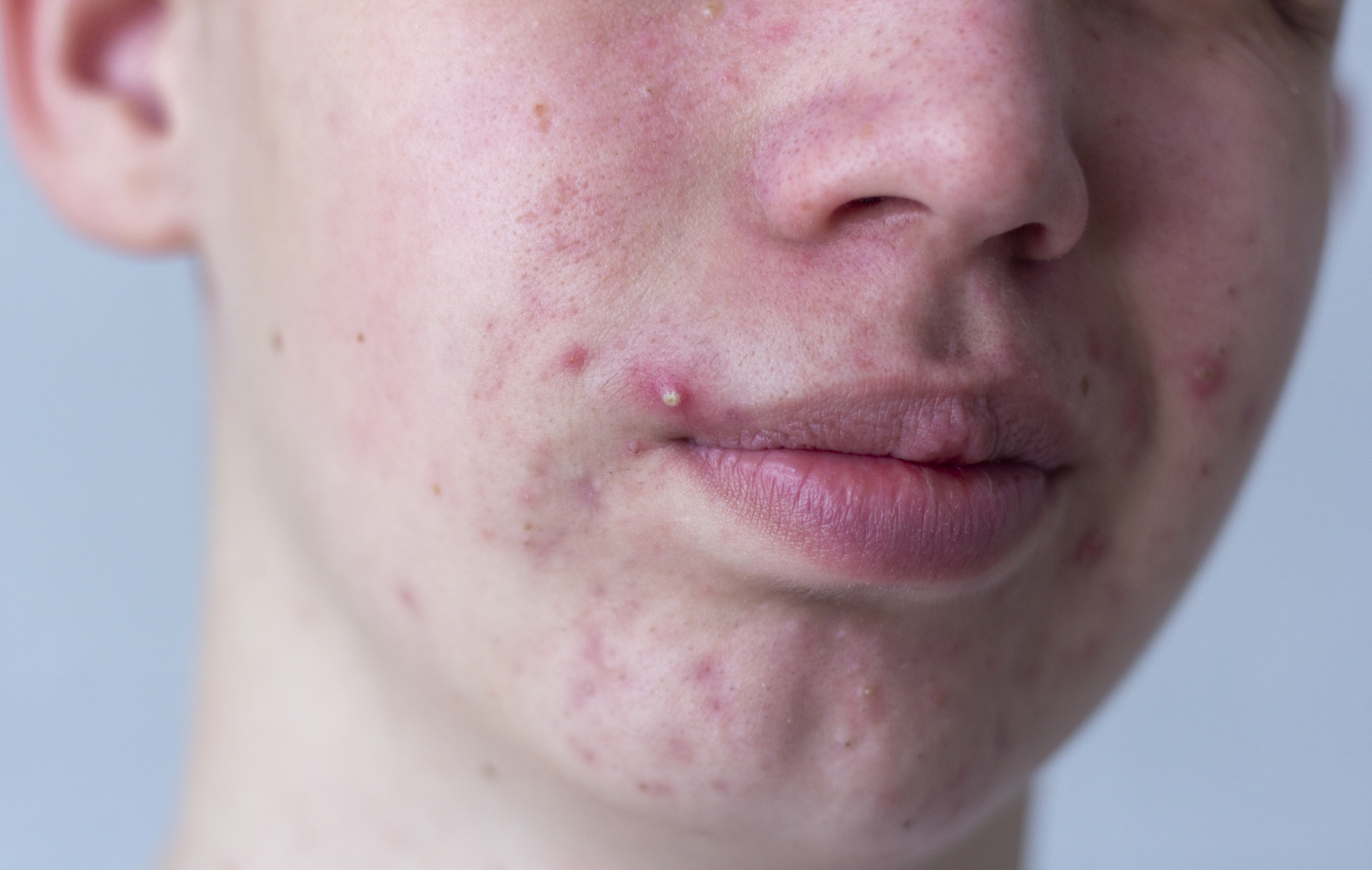 Morpheus8 for acne
