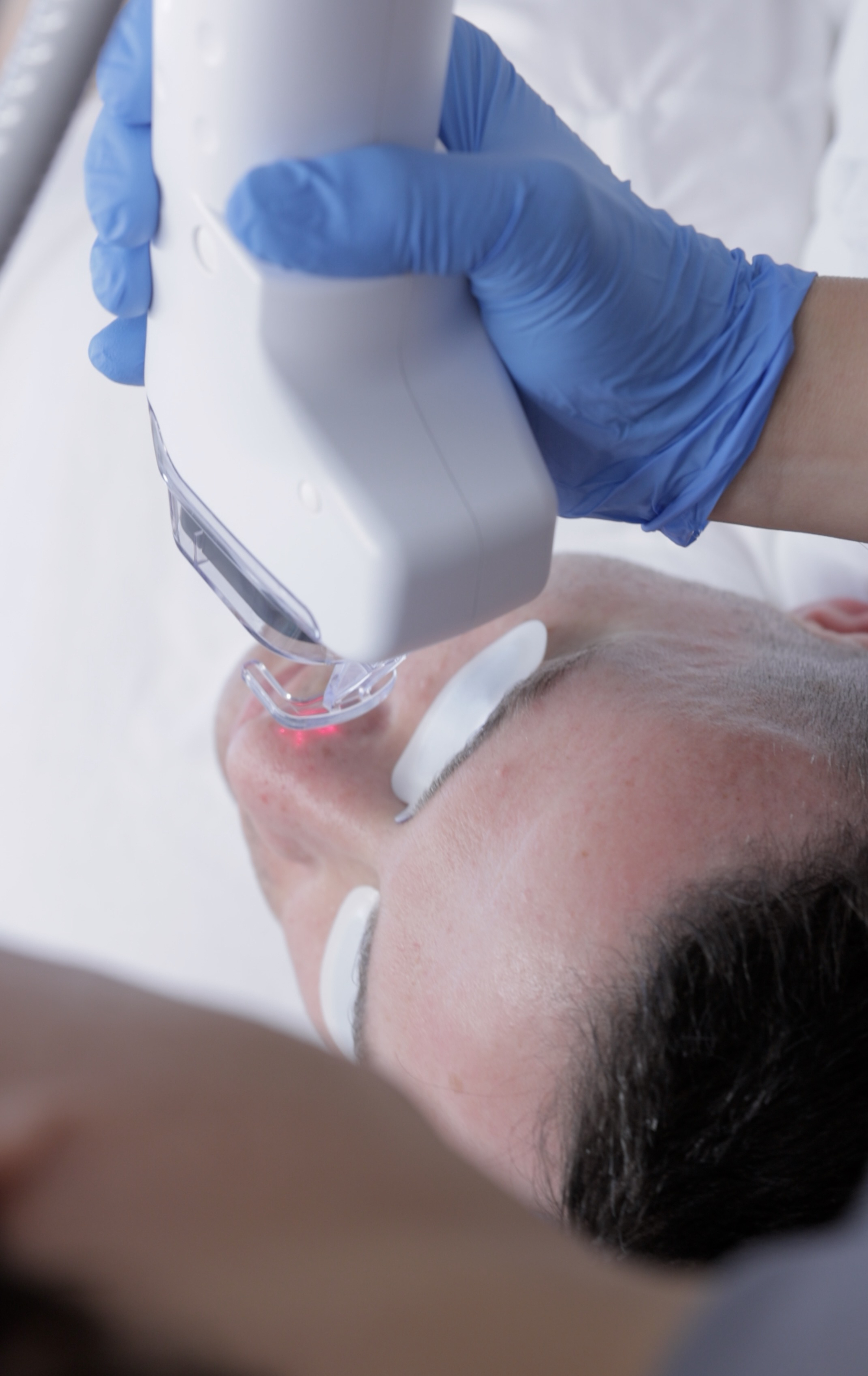 EdgeOne Resurfacing deep CO2 laser treatment at SoHo Men's Health