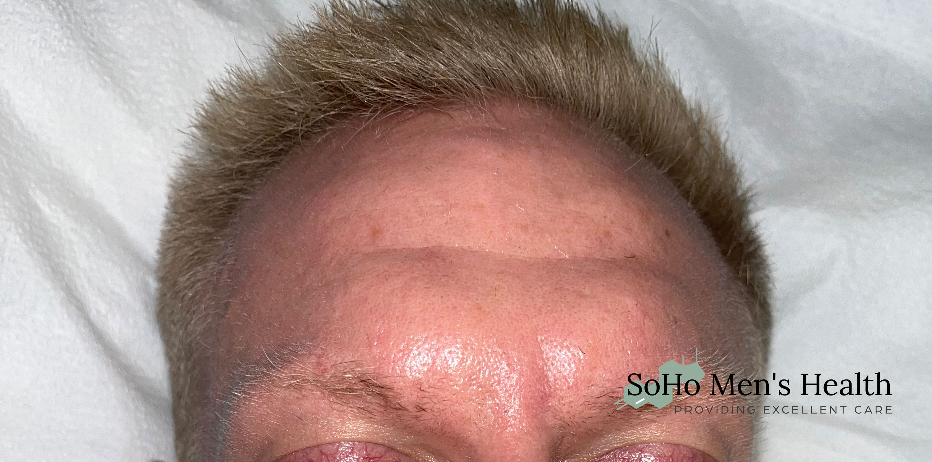 Morpheus8 before result 4