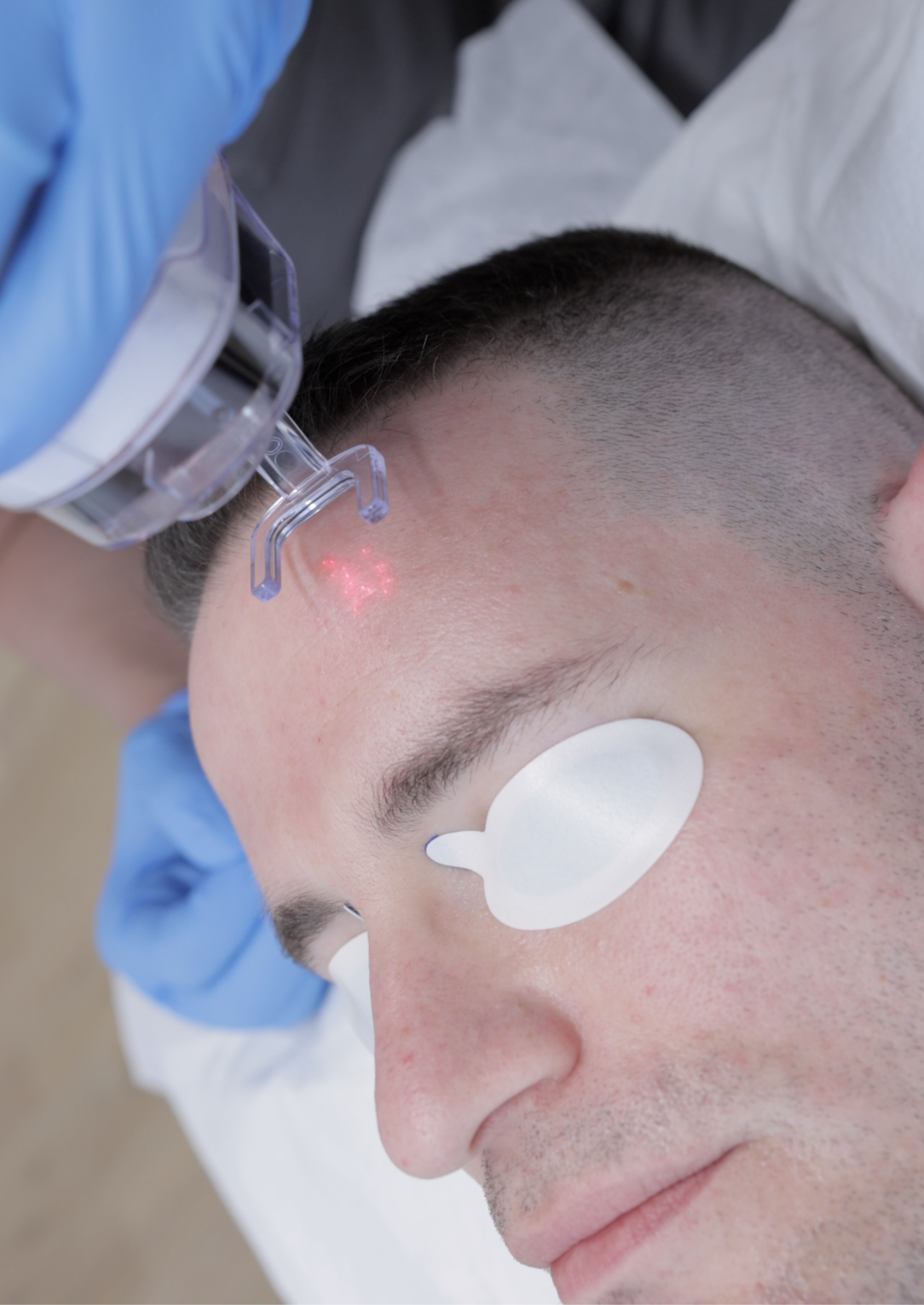 EdgePolish CO2 laser treatment at SoHo Men's Health