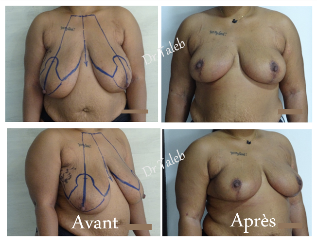 Reduction mammaire