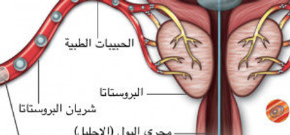 قسطرة البروستات