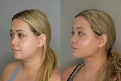 botox & fillers model for Allswell Wellness LLC