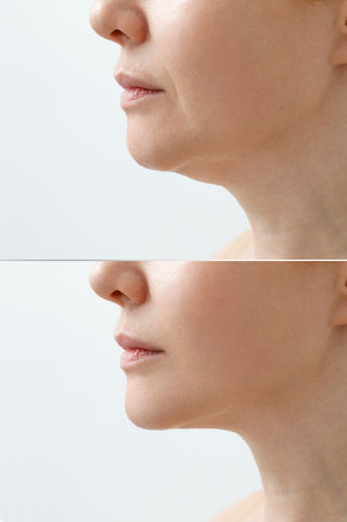 Fillers model for Allswell Wellness LLC