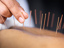 Acupuncture_732x549-thumbnail.jpeg