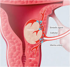 Fibroids Uterine Artery Embolization with Faster Recovery and Less Pain