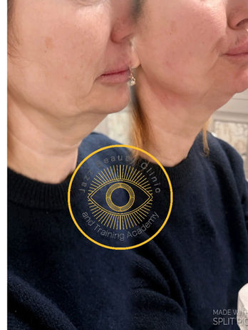 Endo lift results on a woman wearing a blue sweatshirt