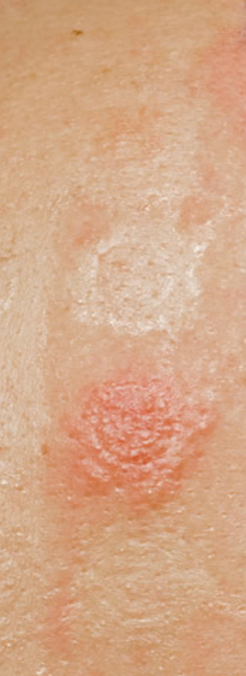 Allergy reaction from hair colour
