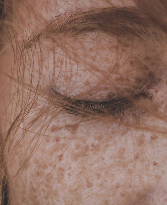 Biostimulator treatment at Reborne, Marylebone, London