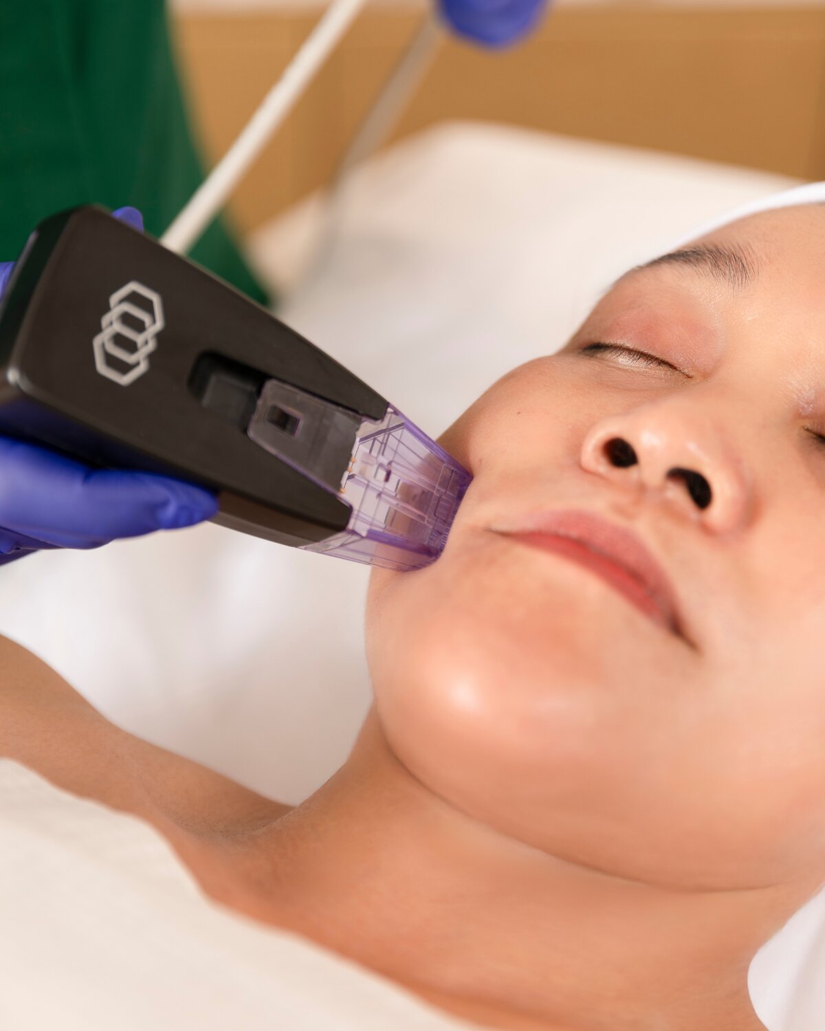Morpheus8 treatment on the cheek at Reborne, Marylebone, London