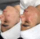 ACNE BOOTCAMP.jpeg