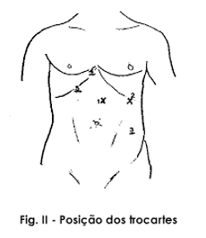 PUNÇÕES CIRURGIA DE HÉRNIA DE HIATO
