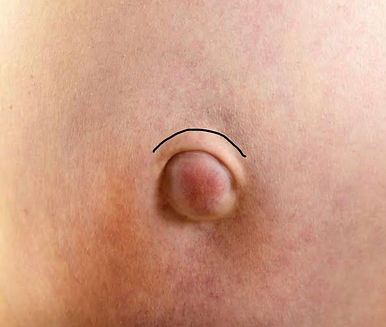 incisão cirurgica da hérnia umbilical