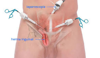hernia inguinal laparoscópica