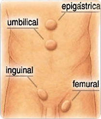 tipos de hérnia abdominal