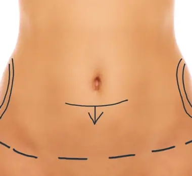chirurgie-esthetique-de-la-silhouette-lifting-du-ventre.jpg.webp