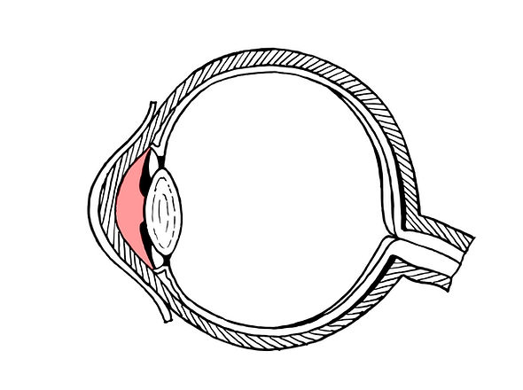 Anterior_uveitis.jpg