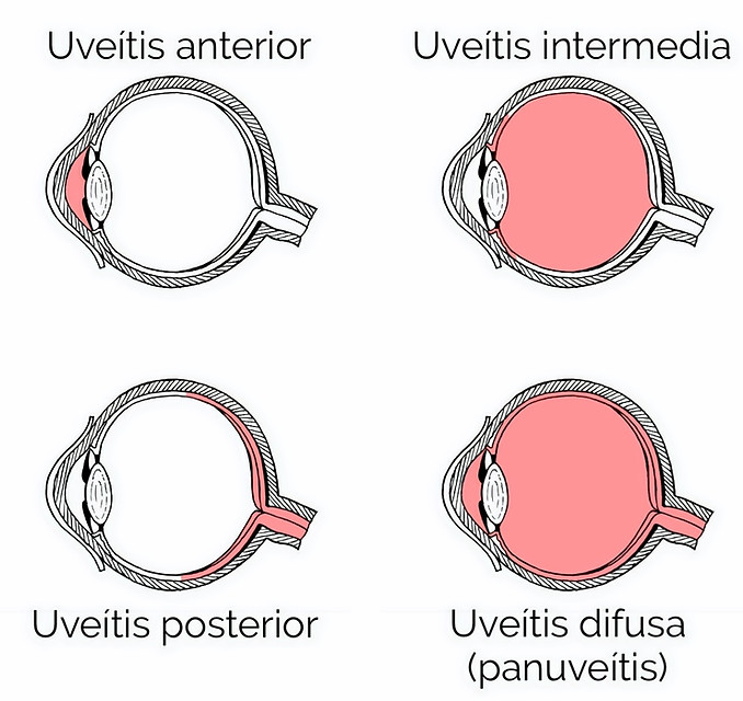 Uveitis_unidas_2_edited.jpg