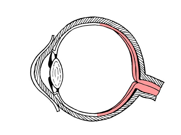 Posterior_uveitis_official.jpg