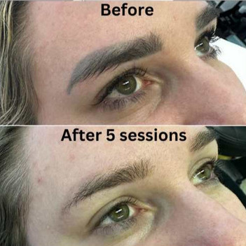 Outer Ink Laser Tattoo Removal Gold Coast