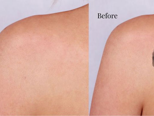 Removing Unwanted Tattoos with Laser: Tips to Get the Best Results