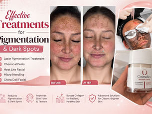 What Treatments Help Reduce Pigmentation and Dark Spots?
