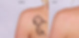 tatto-removal.jpg