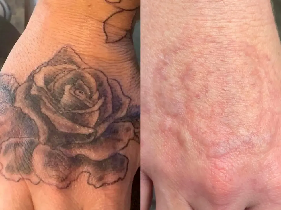 tattoo removal before after