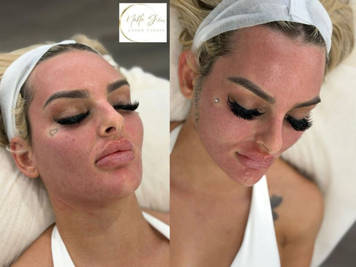 Signs You Could Benefit from Skin Needling Services in Campbelltown