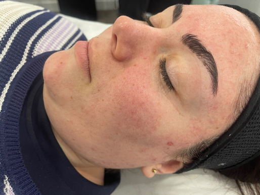 How to Prepare for Your First Acne Scar Treatment in Macarthur
