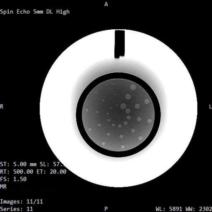 MRI Slice 11 of ACR Large Phantom displaying the low-contrast object detectability test pattern with spokes.