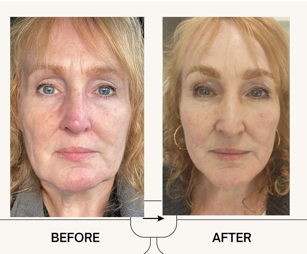 What Is Polynucleotides Treatment and How Does It Rejuvenate Your Skin?