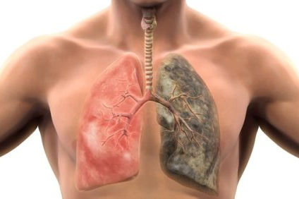 Cáncer de pulmón es el cáncer que más vidas cobra en Chile