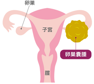 広尾レディース~恵比寿本院~ 卵巣嚢腫