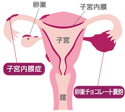 クリエイティブサイトロジー 2　子宮内膜… 15.女性生殖器 (2)子宮内膜症|病理コア画像
