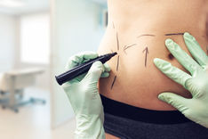 I vantaggi e gli svantaggi delle soluzioni chirurgiche per la cura della cellulite