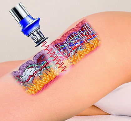 onde d'urto cellulite lissone tefiti centro medico