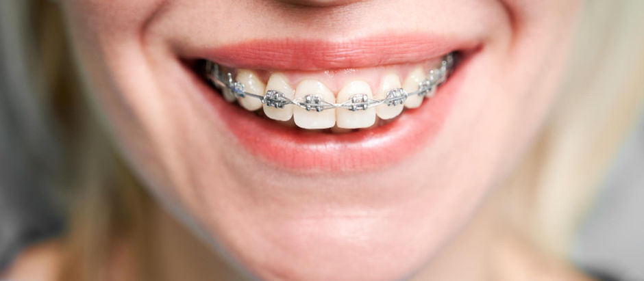 Braces