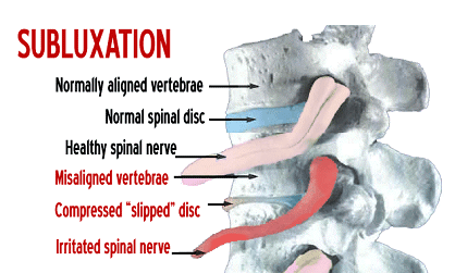 subluxation-small.gif