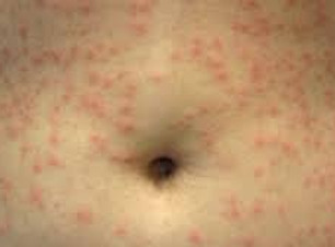 foliculitis 3.jpg