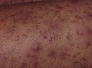 foliculitis-300x229.jpg