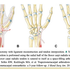 One-Year Outcomes of Ligament Reconstruction Tendon Interposition versus Suture Tape Suspensionplasty for Thumb Carpometacarpal Joint Arthritis - Article Summary