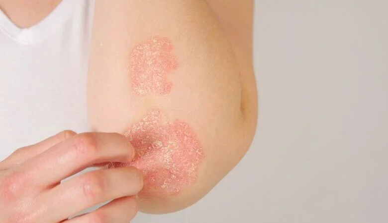 Psoríase: doença crônica, não contagiosa e cercada de mitos