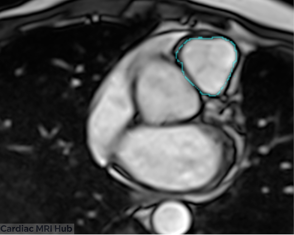 Short axis of pulmonary valve outlined in the above picture.
