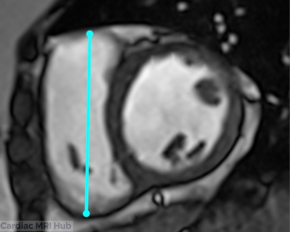 Right ventricle 2 chamber view planning on short axis MRI image with cyan lines parallel to septum