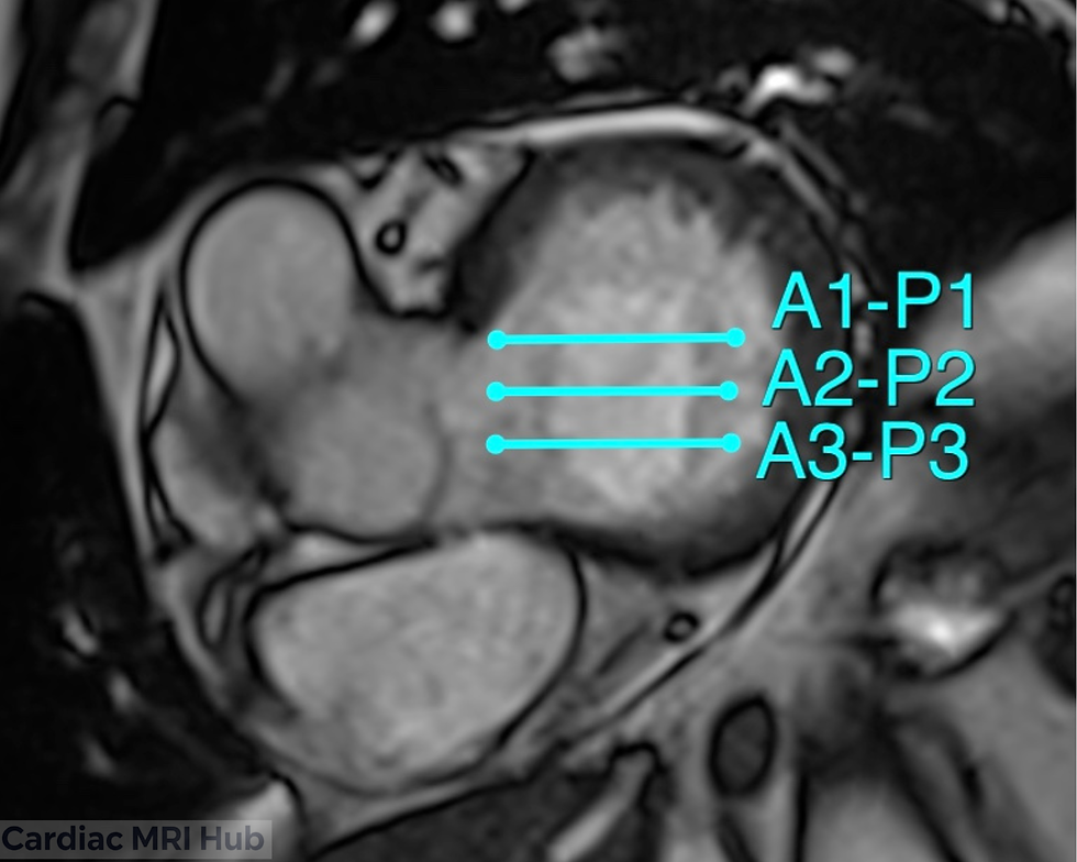 Imaging planes shown for planning of mitral valve leaflets which have 3 anterior and posterior segments or scallops.