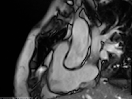 Right Ventricle 3 Chamber View
