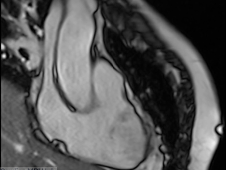 Right Ventricle Inflow View