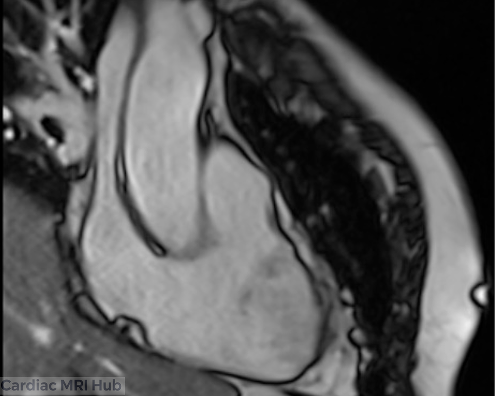 Right Ventricle Inflow View
